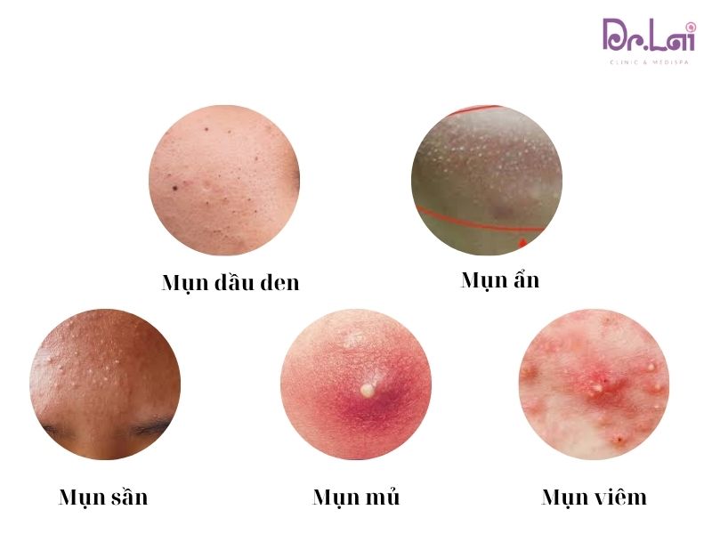 Hiểu đúng về điều trị mụn chuẩn y khoa và spa thông thường