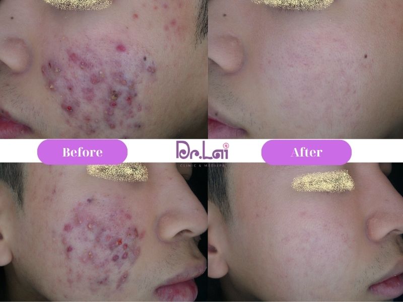 Phòng khám da liễu Dr Lai – Nơi chuẩn hóa quy trình trị mụn tại Hà Nội